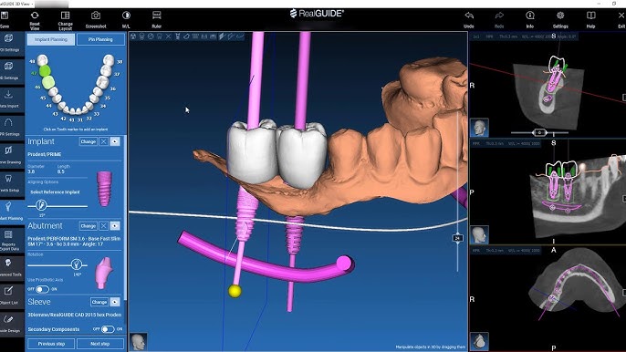 PlastyCAD – Free-Form CAD Software for Prosthesis & Dental Modelling